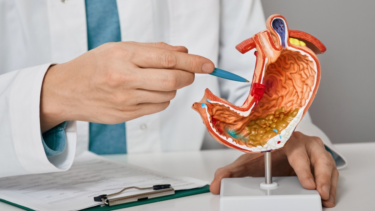 Gastroenterologist consultation, treatment of stomach diseases and ulcers. Doctor pointing to gastric ulcer on anatomical model of stomach