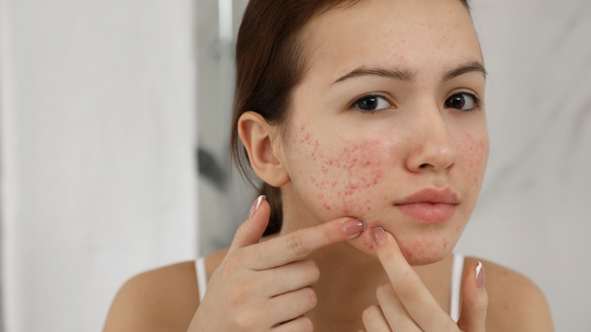 Teen girl with acne problem squeezing pimple indoors