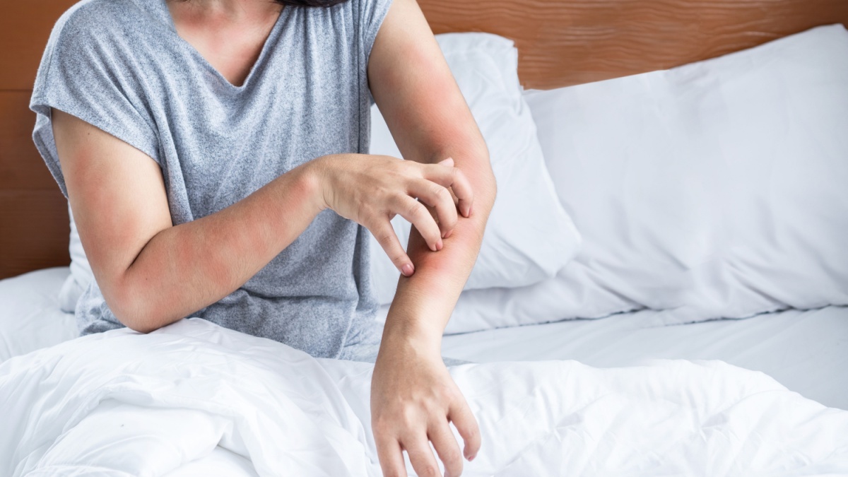 woman have problem with dust mites allergy bedding hand scratching her itchy and rash skin.